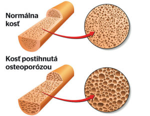osteoporoza